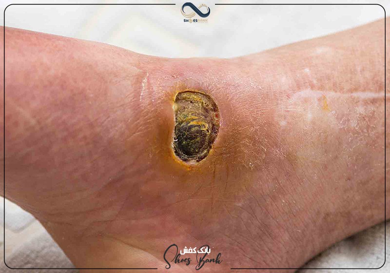 زخم پای دیابتی